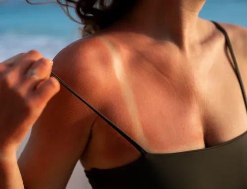 ¿Cómo afectan a la piel las quemaduras por el sol?